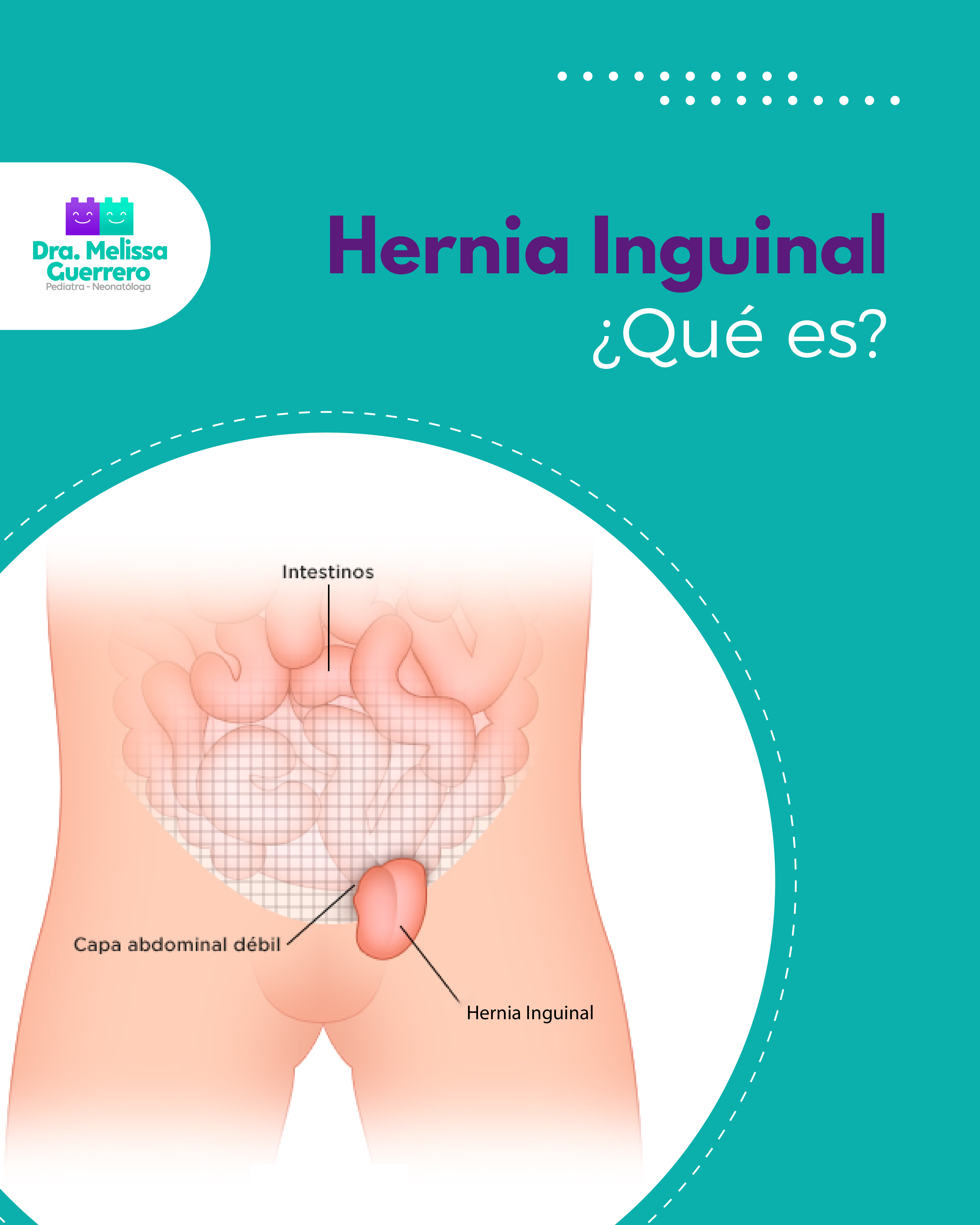 HERNIA INGUINAL